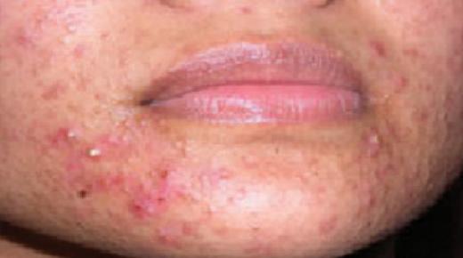 ماذا تعرف عن حب الشباب