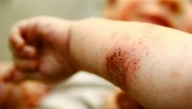 ماذا تعرف عن التهاب الجلد الضوئي النباتي؟