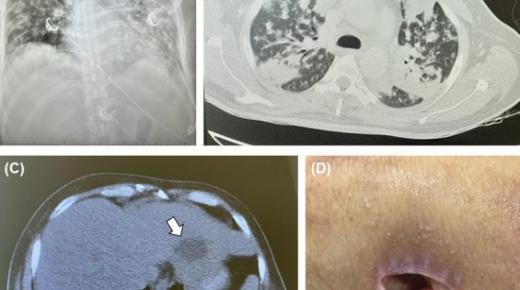 مستشفى بالإمارات يتوصل لخطة علاج مبتكرة لمرض بكتيري خطر