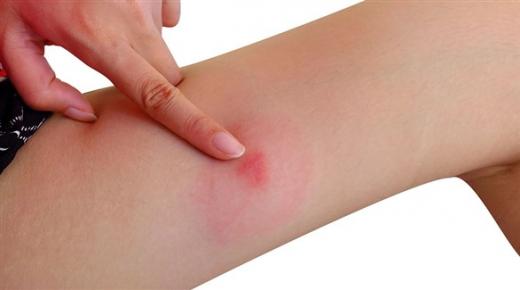 تدابير لمواجهة لدغات البعوض