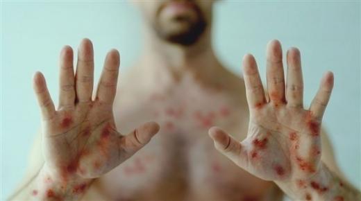 بعد إعلان “جدري القرود” حالة طوارئ عالمية.. “أبوظبي للصحة العامة” يوضح أبرز إجراءاته الوقائية