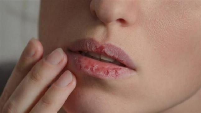 جفاف الفم علامة على الإصابة بأمراض خطيرة