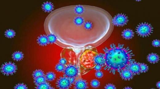 أخصائي أورام يكشف أخطر عمر للإصابة بسرطان البروستاتا