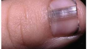 الأظافر تكشف ارتفاع نسبة الكوليسترول