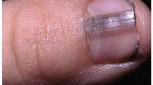 الأظافر تكشف ارتفاع نسبة الكوليسترول