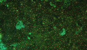 بصمات وراثية جديدة للتنكس البقعي المرتبط بالعمر