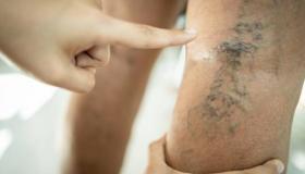 دوالي الساقين.. وهن الأوردة