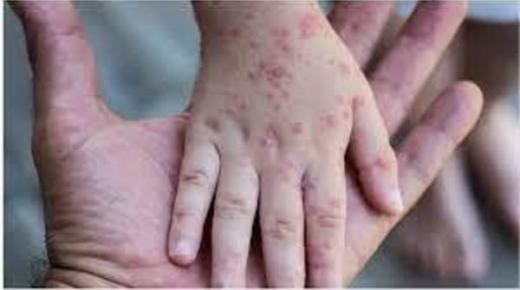 البحرين تسجل أول إصابة بجدري القرود