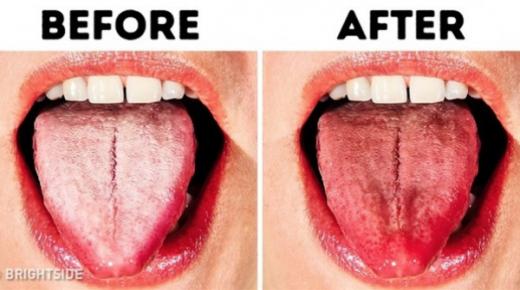 5 طرق للتخلص من اللسان الأبيض وجعله أكثر صحة