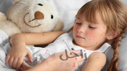 على ماذا تدل أنواع البقع في جسم الطفل