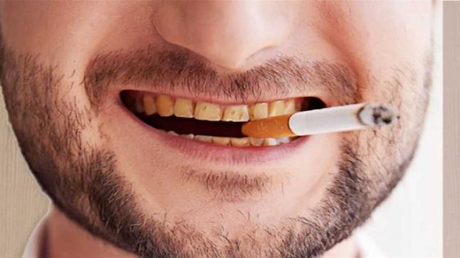 أضرار تصيب لثتك وأسنانك بسبب التدخين.. أبرزها سرطان الفم