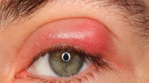 إحذروا من أكياس الماء فوق العين.. أولى علامات الكولسترول