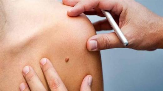 الشامة السرطانيّة.. هكذا يُمكن تمييزها