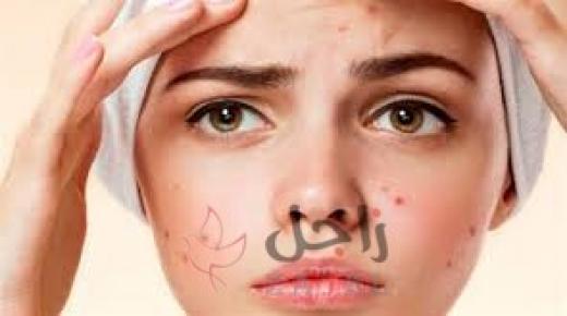 مشكلات صحية تعرف انك تعاني منها من خلال ظهور حب شباب على بشرتك