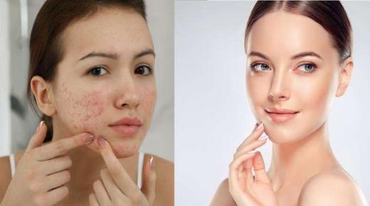 لبشرة أكثر صفاءً.. هذه أفضل وأسوأ أغذية لعلاج حب الشباب