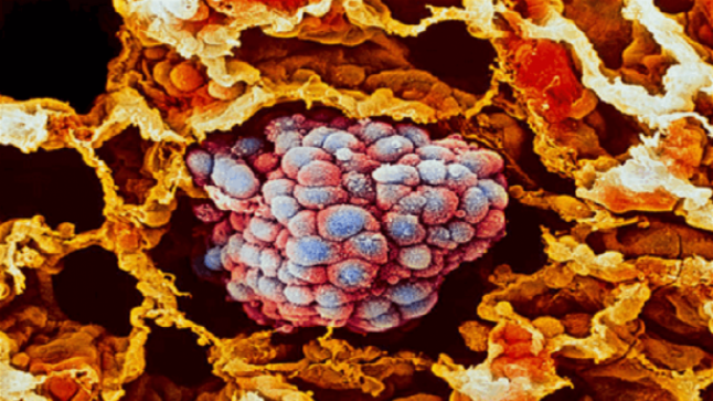 اكتشاف طريقة جديدة لتحفيز المناعة لتدمير السرطان