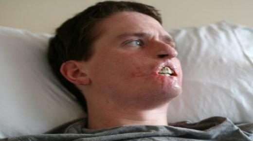 البكتيريا آكلة لحوم البشر تنتشر في مناطق غير متوقعة وتهدد حياة الأمريكيين