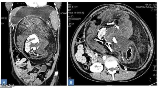 تكتشف انها مصابة في حالة طبية نادرة جدا  شابة هندية، بالغة من العمر 17 عاما