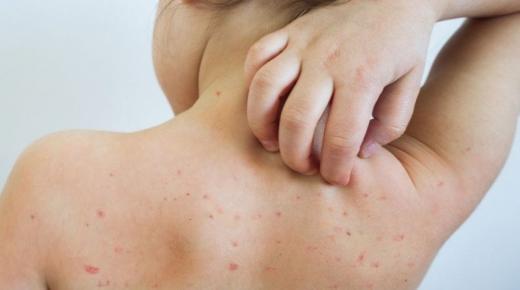 منظمة الصحة العالمية توضّح التطعيم ضد جدري القرود