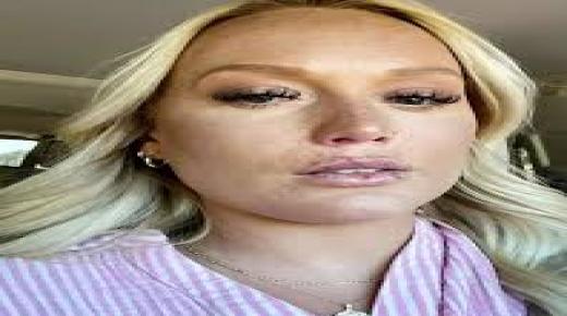 أم تحذر من البوتكس عقب إصابتها بالشلل جراء حقنة تجميلية