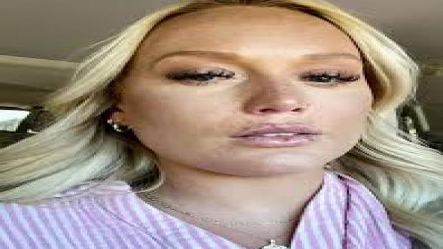 أم تحذر من البوتكس عقب إصابتها بالشلل جراء حقنة تجميلية