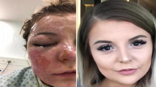 “يحة خطأ على الإنترنت” تسببت بفَقْد فتاة إحدى عينيها