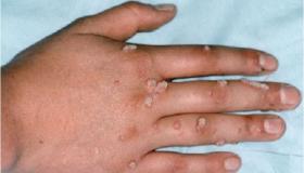 اعراض جدري القرود