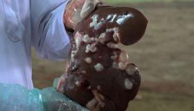 اصابات حمى القرم النزفية تتزايد في العراق