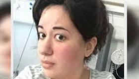 “اميلي سودلو”خضعت لجراحة في الدماغ دون تخدير