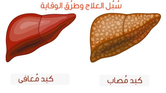 تراكم الدهون في الكبد ينذر بأعراض صحية خطيرة التدخل المبكر لعلاج الكبد الدهني أمر بالغ الأهمية للوقاية من عدة أمراض