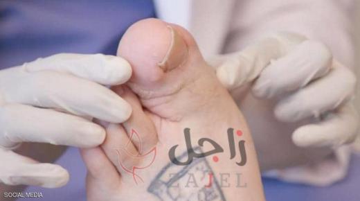 أصبح القدم العملاق..اضطراب حول حياة شاب الى مأساة