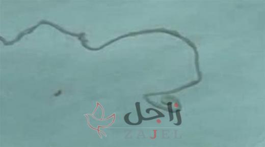 إخراج دودة من رأس شاب كانت تسكنه منذ 12 عاماً