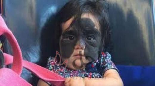 الطفلة التي أثارت تعاطف العالم..”رضيعة باتمان” تبدأ رحلة العلاج