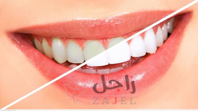 10 طرق طبيعية لازالة اصفرار الاسنان