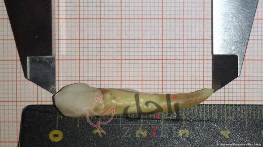 طبيب يقتلع أطول سن بشري ويدخل موسوعة غينيس