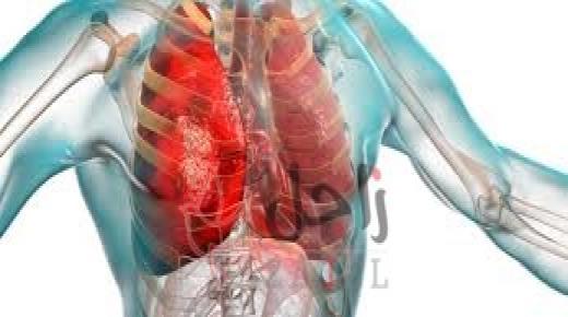 الالتهاب الرئوي يقتل طفلا كل 39 ثانية