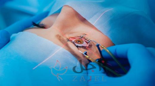 تحذيرات من عمليات الليزك ومطالب بوقفها فوراً لهذه الأسباب