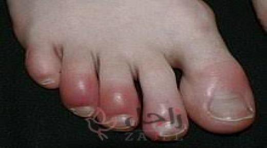 تورم أصابع القدمين في الشتاء.. طرق منزلية بسيطة لعلاجه