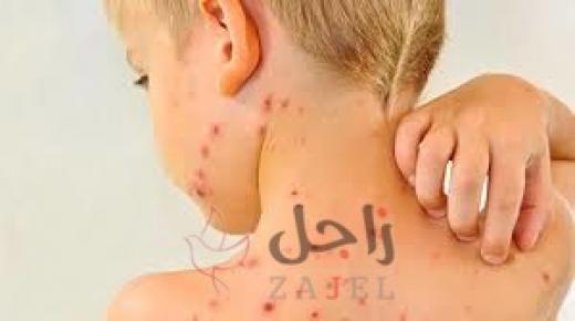 تسجيل 11 حالة إصابة جديدة بالحصبة في أمريكا الشهر الماضي