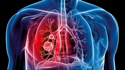 سرطان الرئة.. طرق للوقاية واحصائيات مرعبة