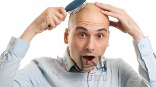 ساعات العمل الطويلة تزيد من إصابة الرجال بالصلع (دراسة)