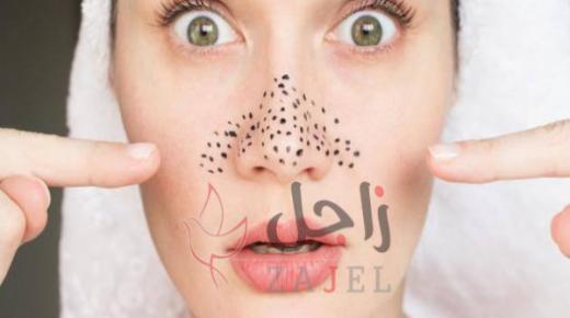 4 وصفات طبيعية لعلاج الرؤوس السوداء.. “سهلة ومضمونة”