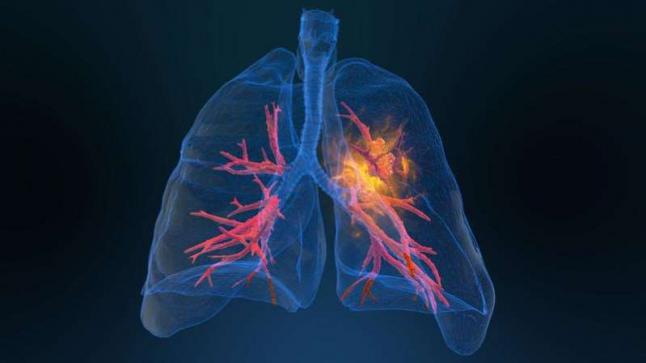 أسباب ومضاعفات والوقاية من سرطان الرئة