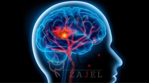 6 علامات تنذر بسكتة دماغية