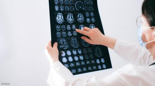 ما الذي تعرفه عن “المادة البيضاء” في الدماغ؟