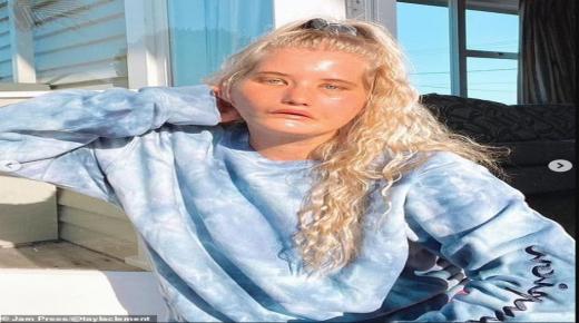 شركة أزياء توظف فتاة مصابة بشلل في الوجه …محرومة من الابتسامة