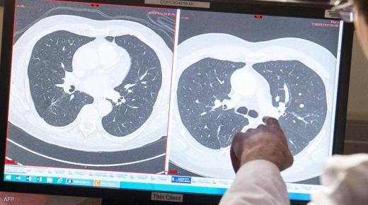 تقنية واعدة تجعل الورم السرطاني “يأكل نفسه”