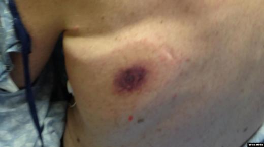 ما هي” البكتيريا اكلة اللحلوم” التي تسبب الوفاة ؟؟