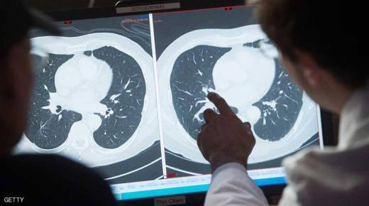 اكتشاف “تقنية طبية” جديدة تفتح باب الأمل لمرضى السرطان